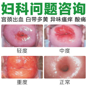 宫颈糜烂重度 span class=h>凝胶 /span>阴道私处用药盆腔炎白带多