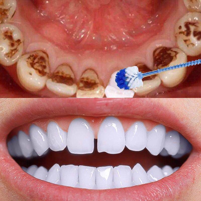 牙齿美白神器洗牙洁牙粉速效去黄牙烟牙渍牙垢氟斑牙去上火除口臭