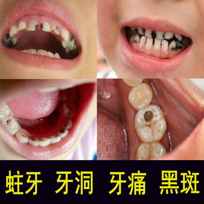 蛀牙修复牙洞膏黑斑儿童龋齿虫牙防蛀牙膏粉成人孕妇牙疼牙痛特效