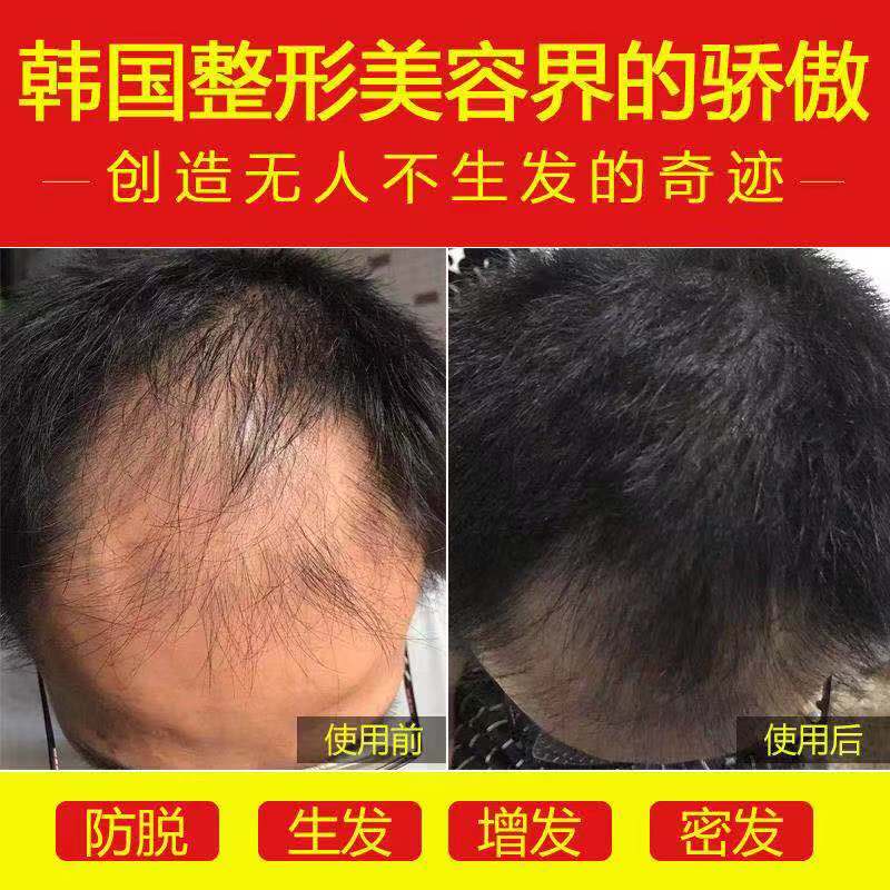 J9生发剂额头生长增长液男女密发防脱增发育发毛囊激活发际线神器