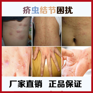 疥虱康宁特效止痒膏庎螨硫磺软膏疥虫卵外阴囊结节疥舒宁虱芥康王