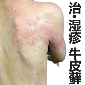 湿疹皮肤专用治疗炉甘石洗剂止痒去根包邮私处湿疹成人外用