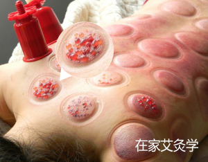 买一发三 艾灸贴艾贴艾灸盒随身灸家用家庭式艾灸仪器艾条温灸器艾灸盒