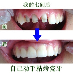 自己动手粘烤瓷牙假牙胶水粘牙贴面粘瓷牙粘牙胶正品包邮