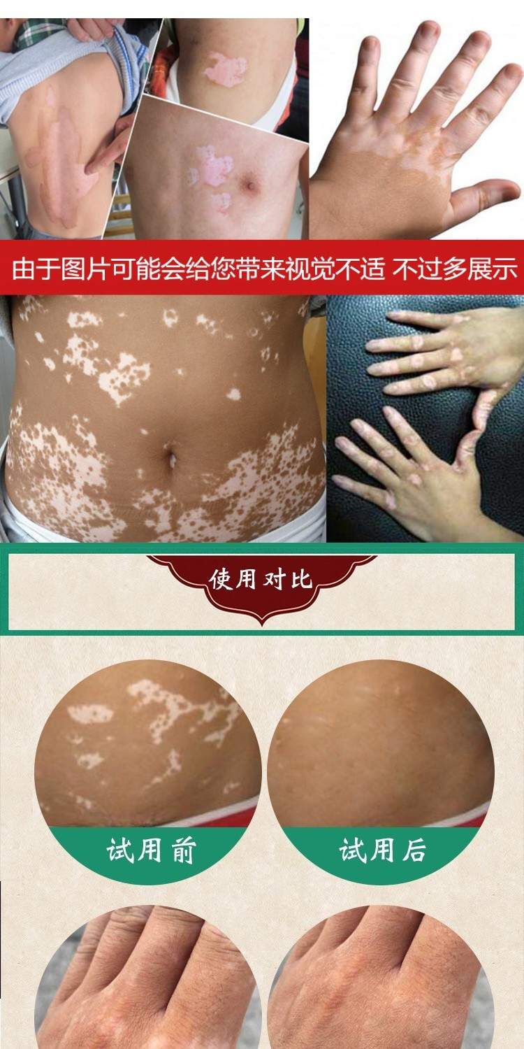 去汗斑花斑膏成人皮肤外用汗斑大腿汗班藓花班皮肤外用癣乳膏白斑