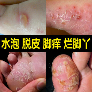 治脚气专除脚痒脚臭水泡型脱皮止痒真菌感染灰