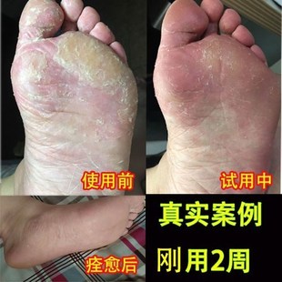 治腳氣噴劑止癢脫皮水泡型泡腳去除腳臭腳癢腳氣王藥膏足光粉