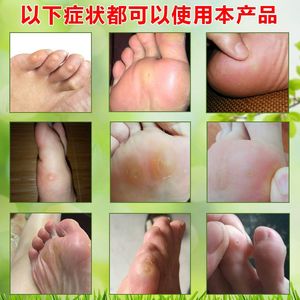 鸡眼贴去除鸡眼老茧刺瘊刺窝脚钉脚茧护理 span class=h>脚垫 /span>